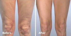 The Forma Difference Non Invasive Skin Tightening Liposuction Com