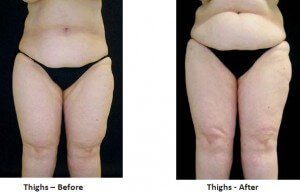 Lipedema Patients Are Turning to Tumescent Liposuction for Relief