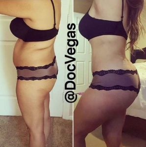bbl, liposuction, Brazilian butt lift, augmentation