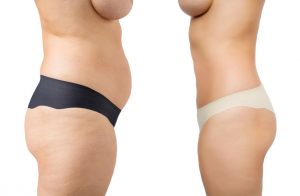 sculpsure