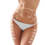 liposuction-image