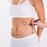 5 common liposuction myths articel photo
