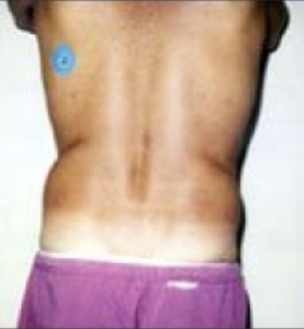 Loose Skin On Flanks - Hansplace