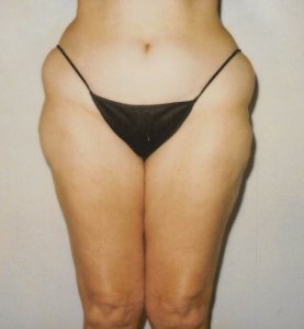 Abs/Flanks - KleinLipo - Liposuction Surgery of Orange County