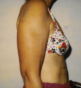 Arm Liposuction - KleinLipo - Liposuction Surgery of Orange County