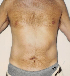 Male Flanks Liposuction - KleinLipo - Liposuction Surgery of Orange County