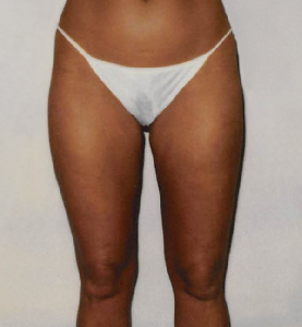 Male Flanks Liposuction - KleinLipo - Liposuction Surgery of Orange County