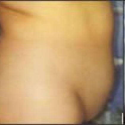 Before: Abdomen