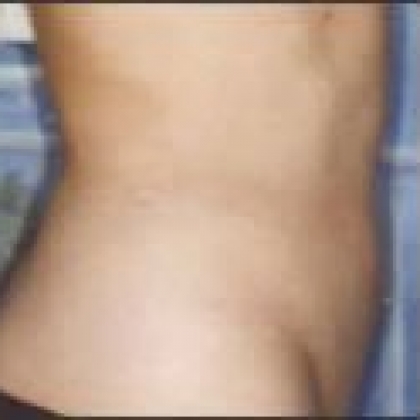 After: Abdomen