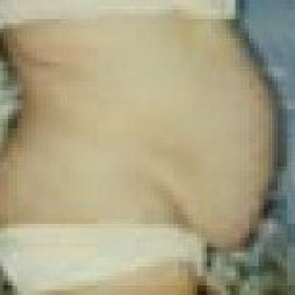 Before: Abdomen