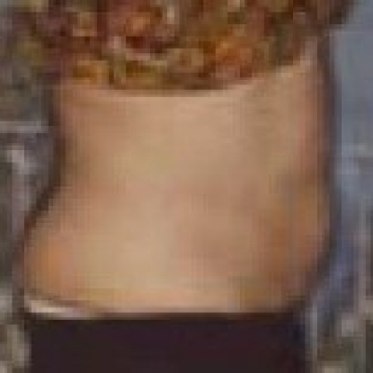 After: Abdomen