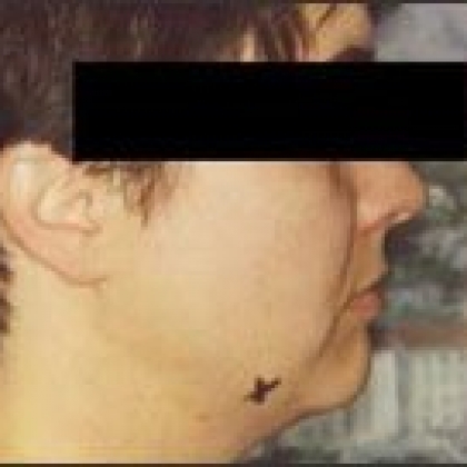 Before: Face and Neck