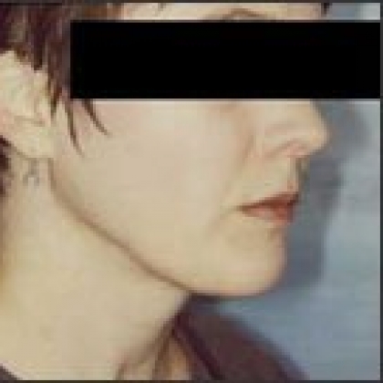 After: Face and Neck