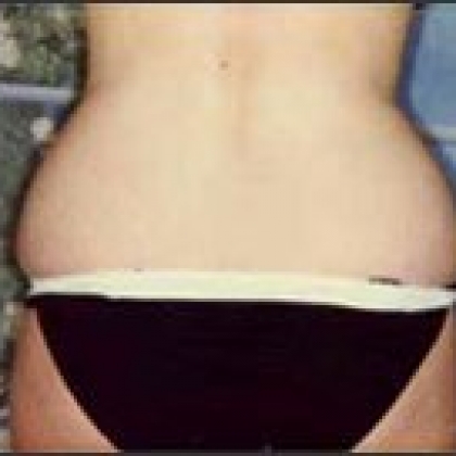 Before: Waist/Hips/Outer Thighs