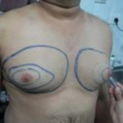 Before: Breasts, Male
