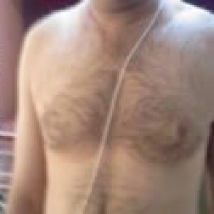 After: Breasts, Male