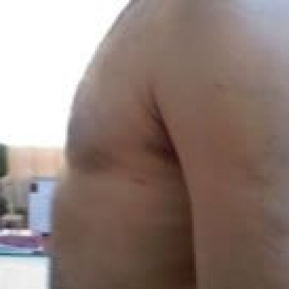 After: Breasts, Male