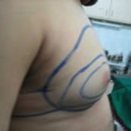 Before: Breasts, Male