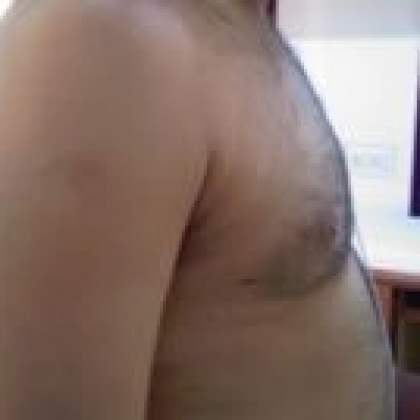 After: Breasts, Male