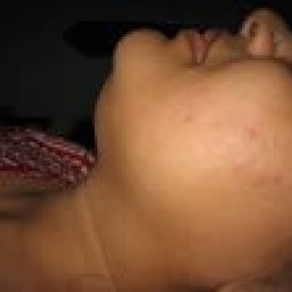 Before: Face and Neck