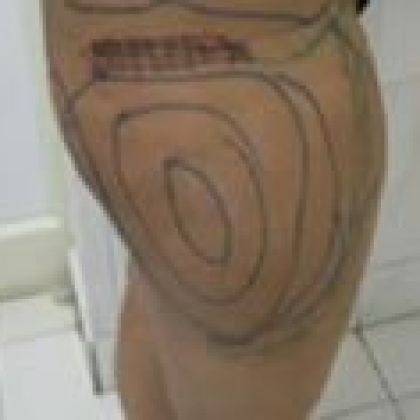 Before: Outer Thighs