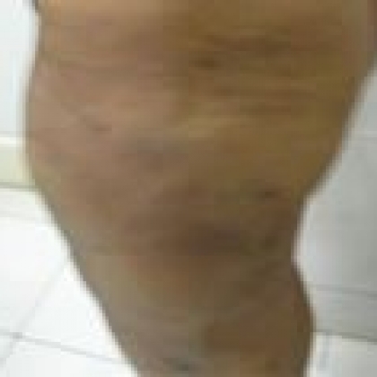 After: Outer Thighs