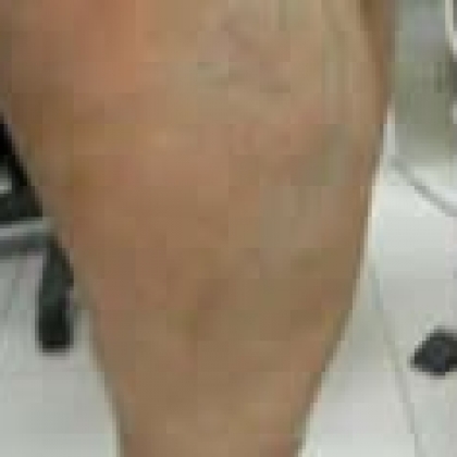 Before: Anterior Thighs and Knees
