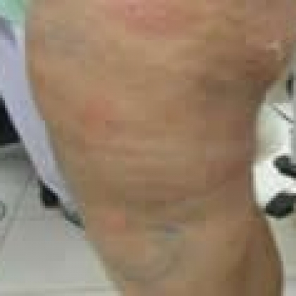 After: Anterior Thighs and Knees
