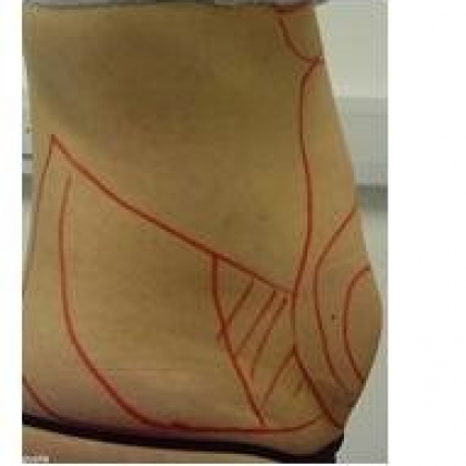 Before: Abdomen