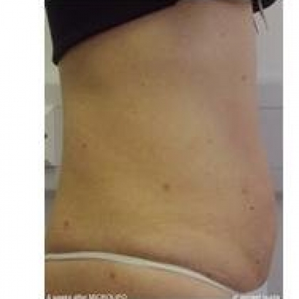 After: Abdomen