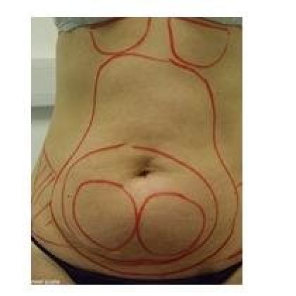 Before: Abdomen