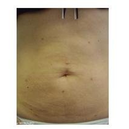 After: Abdomen
