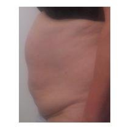 Before: Abdomen