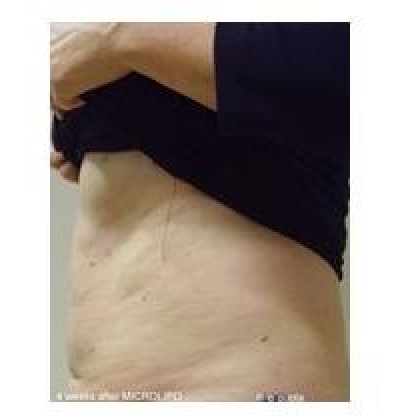 After: Abdomen