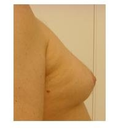 Before: Breasts, Male