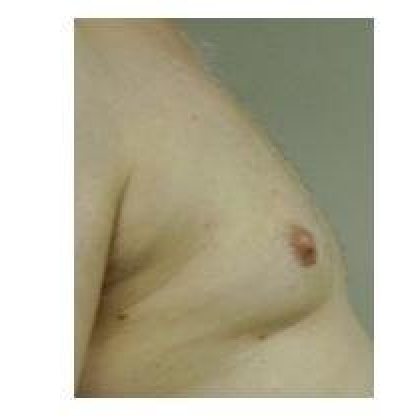 After: Breasts, Male