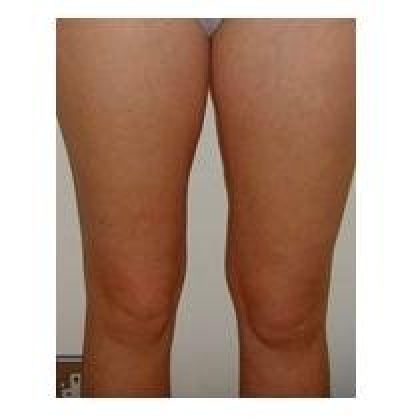 Before: Inner Thighs