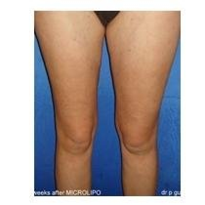 After: Inner Thighs