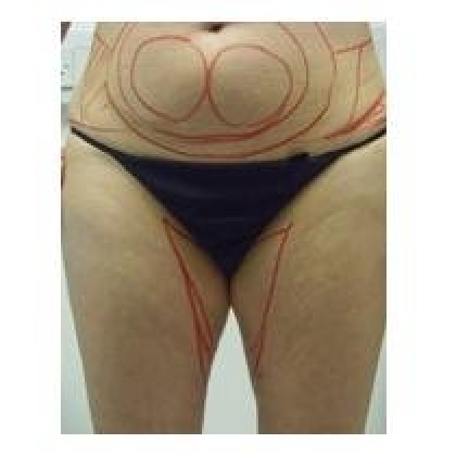 Before: Waist/Hips/Inner & Outer Thighs