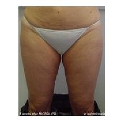 After: Waist/Hips/Inner & Outer Thighs