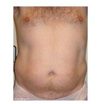 Before: Abdomen, Male