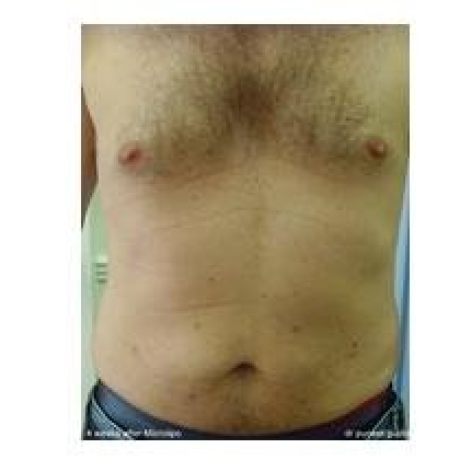 After: Abdomen, Male