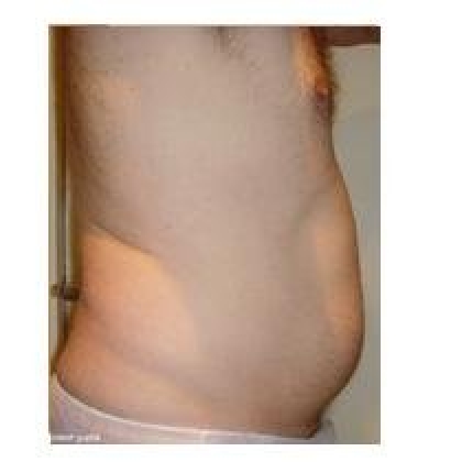 Before: Abdomen, Male