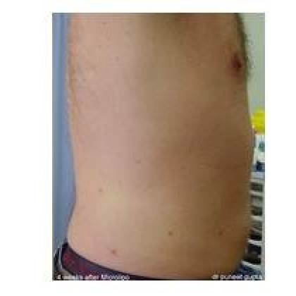 After: Abdomen, Male