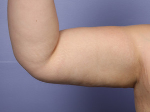 After: Arms