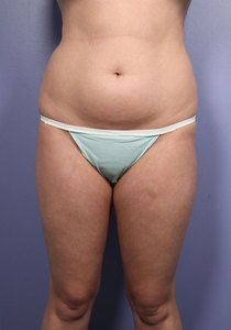 Before: Abdomen