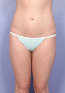 After: Abdomen