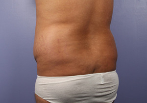 Before: Flanks, Male