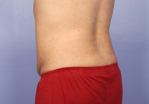 After: Flanks, Male