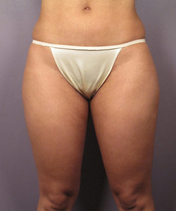 Before: Hips/Outer Thighs